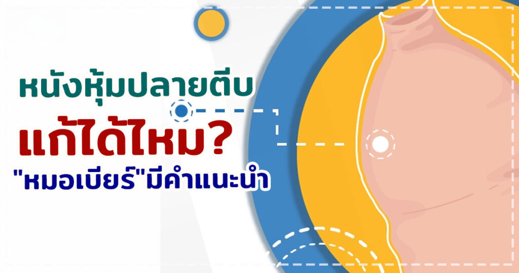 dee - หมอเบียร์ เคลียร์ใจ หนังหุ้มปลายตีบ