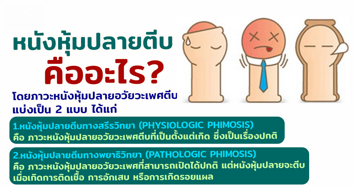 keed - หมอเบียร์ เคลียร์ใจ หนังหุ้มปลายตีบ