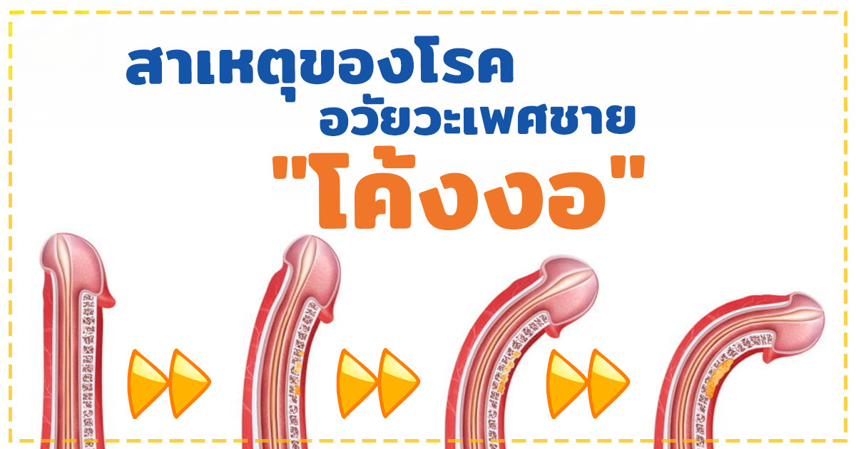 อวัยวะเพศโค้งงอ
