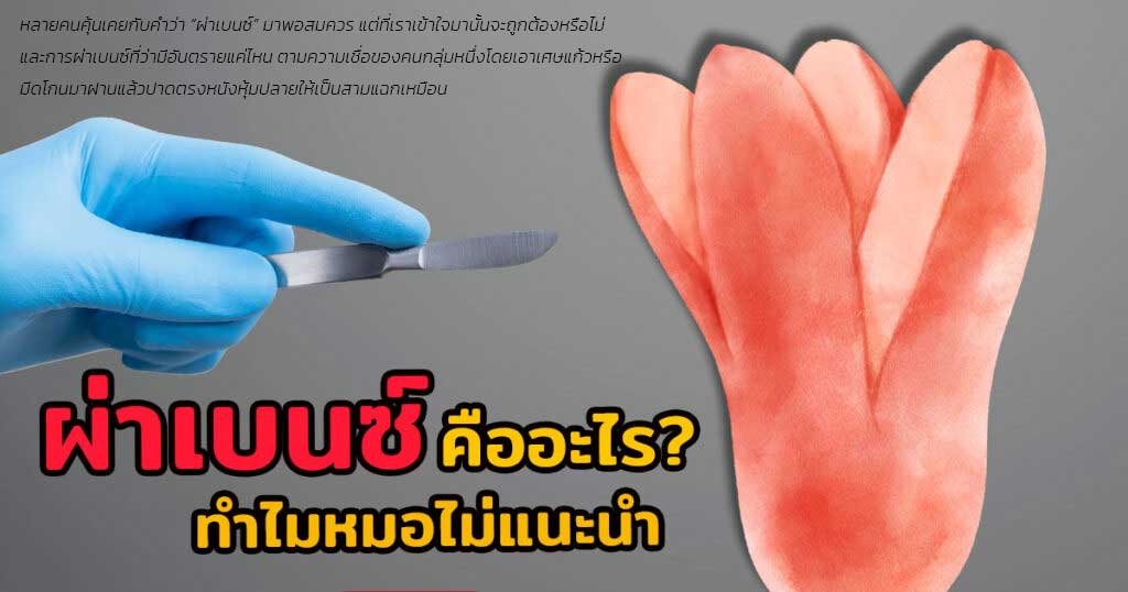 ผ่าเบนซ์คืออะไร