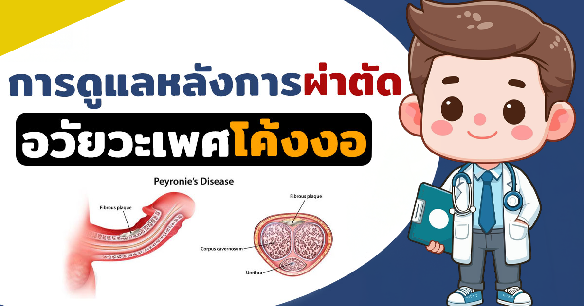 dss - หมอเบียร์ เคลียร์ใจ อวัยวะเพศโค้งงอ