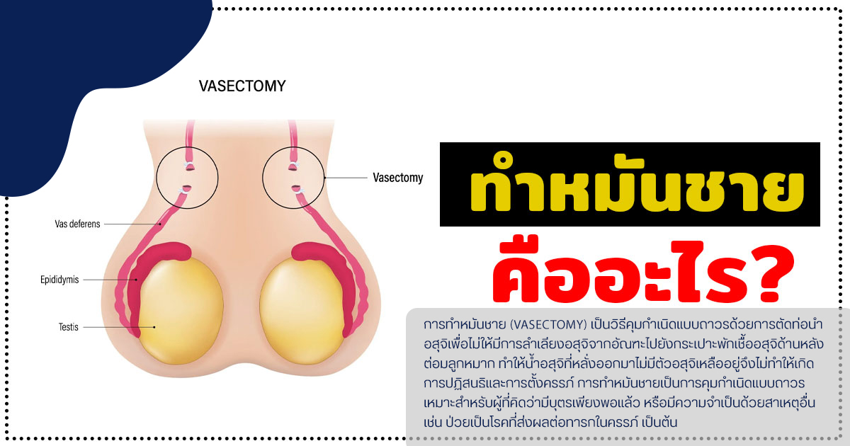 ทำหมันชาย
