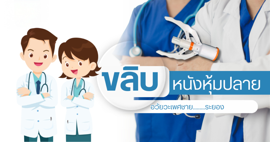 ขลิบหนังหุ้มปลาย